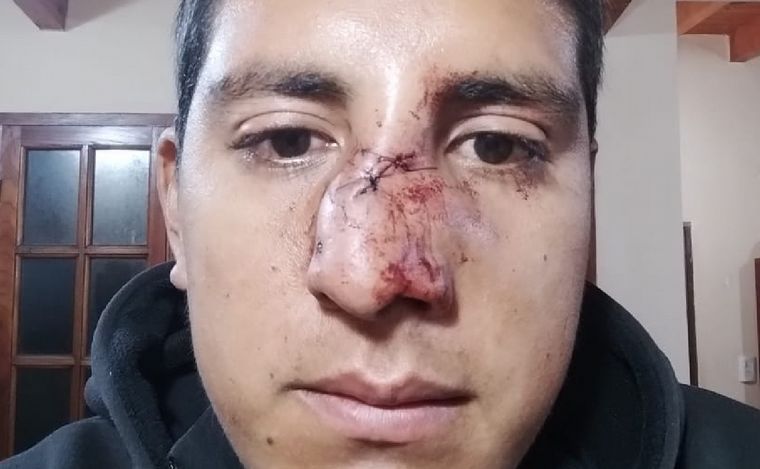 FOTO:  Franco Acosta sufrió la fractura de tabique nasal. 