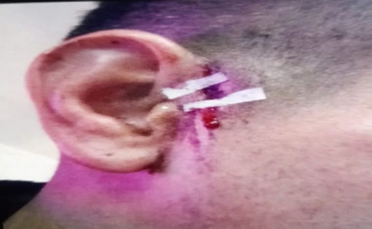 FOTO: Un jugador de la Liga Santafesina de Fútbol fue atacado por otro en la oreja.