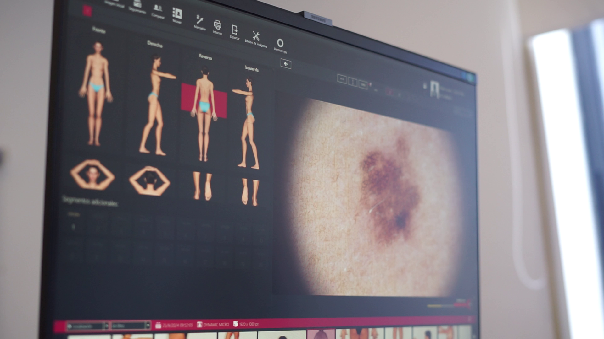 FOTO: Dermatoscopía digital: tecnología avanzada para el diagnóstico de cáncer de piel